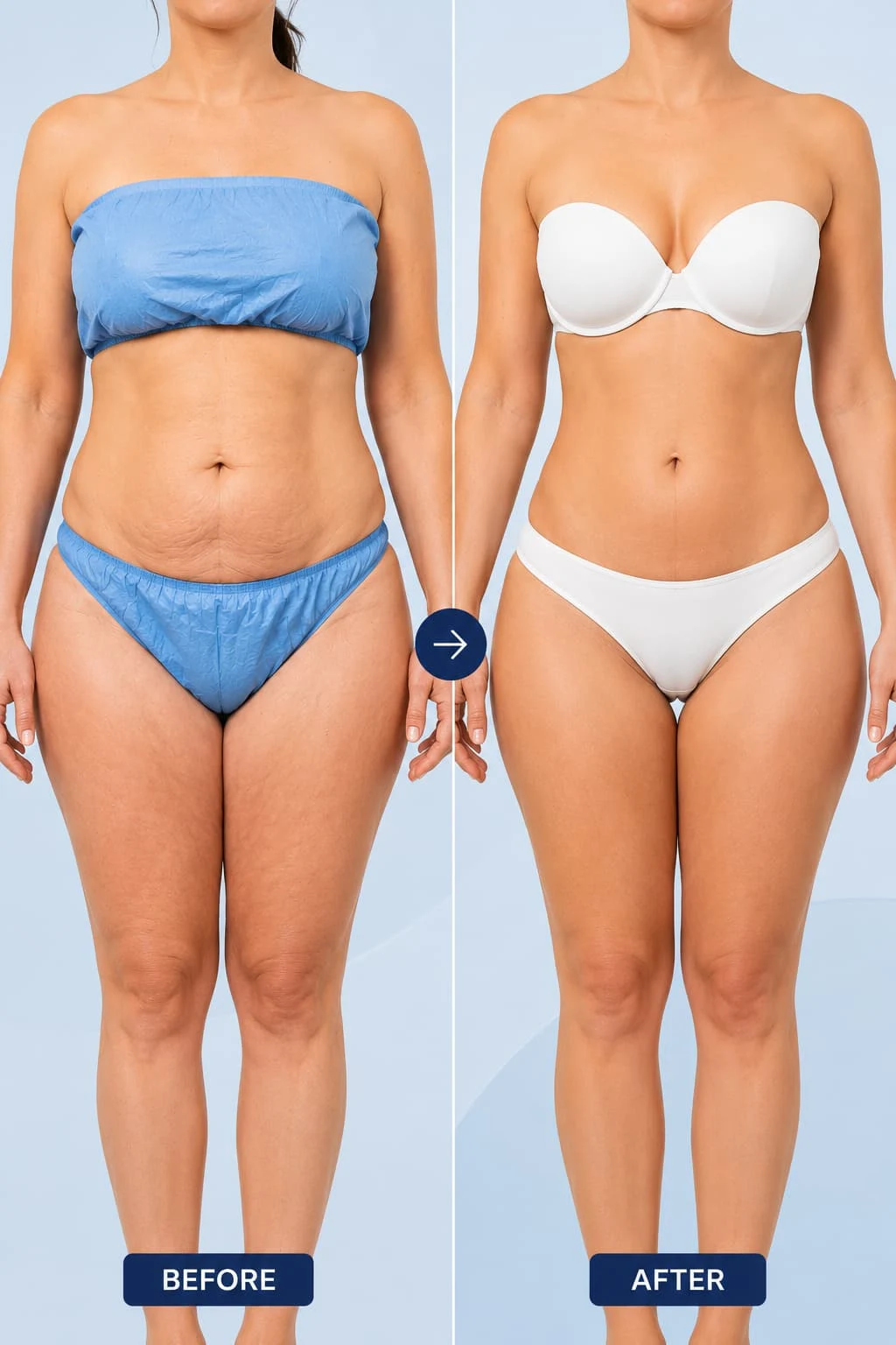 A side-by-side before and after comparison of a woman's torso, showing abdominal and breast contour changes following a cosmetic procedure.